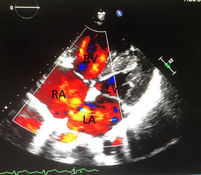 Case report: Conquer a complex variant: Coronary-pulmonary artery fistulas, atrial septal defect and bicuspid pulmonary valve, under beating heart surgery